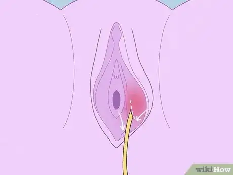 Image titled Get Rid of a Bartholin Cyst Step 7