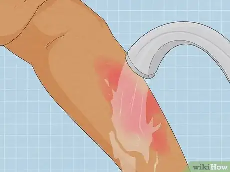 Image titled Treat a Hot Water Spill on Your Skin Step 7