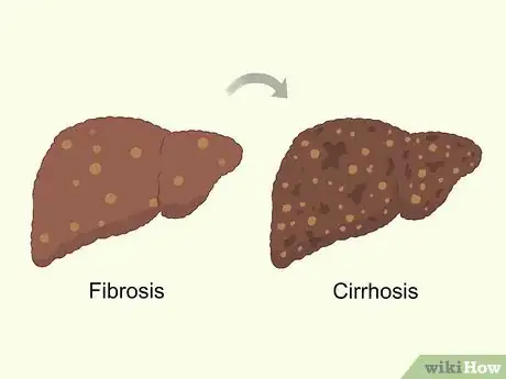 Image titled Treat Liver Fibrosis Step 3