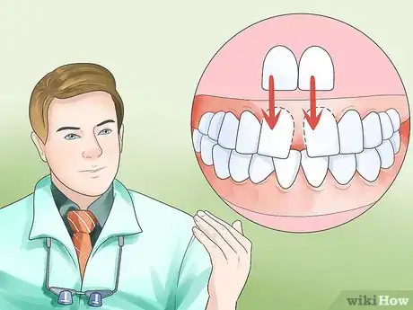 Image titled Determine if You Need Braces Step 15