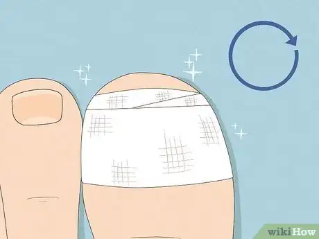 Image titled Remove a Dead Toenail Step 13