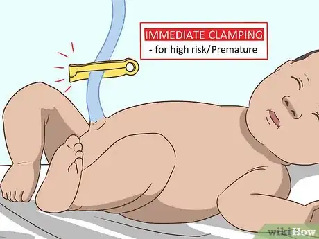 Image titled Cut the Umbilical Cord of a Baby Step 2