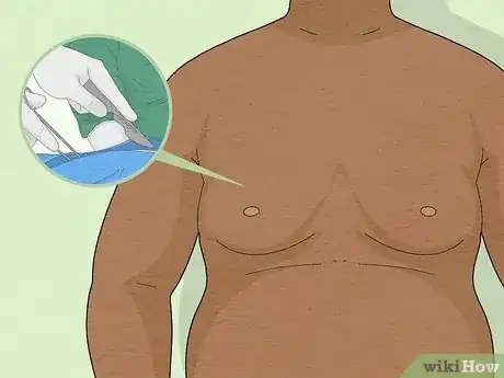 Image titled Detect Gynecomastia Step 16