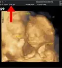 Read an Ultrasound Picture