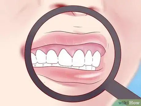 Image titled Tell if You Have Mouth Cancer Step 1