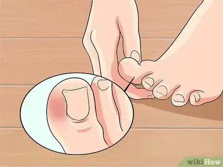 Image titled Cure an Infected Toe Step 1