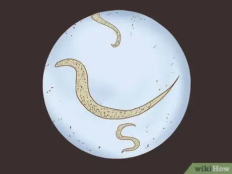 Image titled Recognize and Prevent a Pinworm Infection Step 1