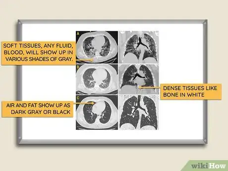 Image titled Read a CT Scan Step 6