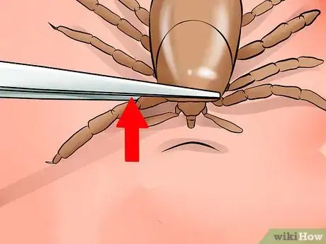 Image titled Treat Tick Bites Step 2