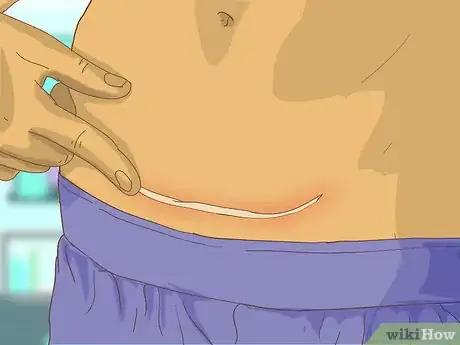 Image titled Care for Your C Section Scar Step 13