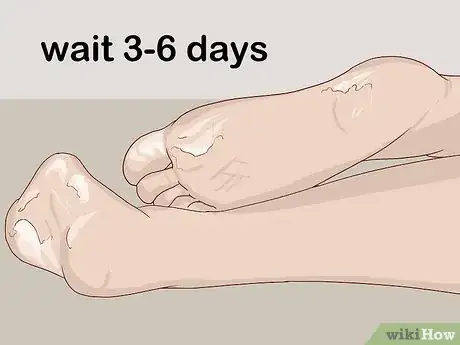 Image titled Use an Exfoliating Foot Peel Step 10