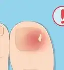 Remove a Dead Toenail