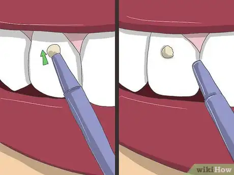 Image titled Apply Tooth Gems Step 11