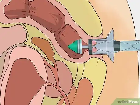 Image titled Stop Bleeding Hemorrhoids Step 12