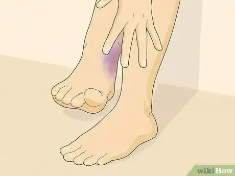 Image titled Know if You Have Neuropathy in Your Feet Step 19