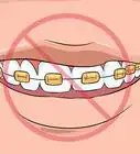 Choose the Color of Your Braces