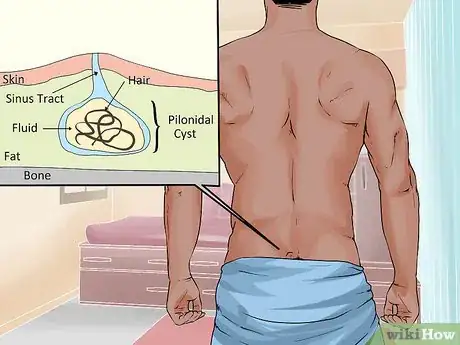 Image titled Treat a Pilonidal Cyst Step 11