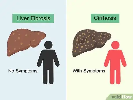 Image titled Treat Liver Fibrosis Step 9