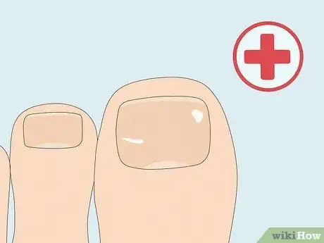 Image titled Cure Nail Fungus Step 19