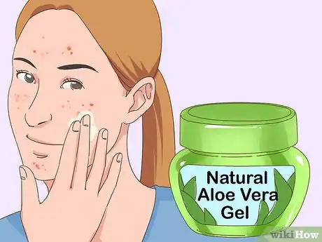 Image titled Get Rid of Acne Fast Step 11