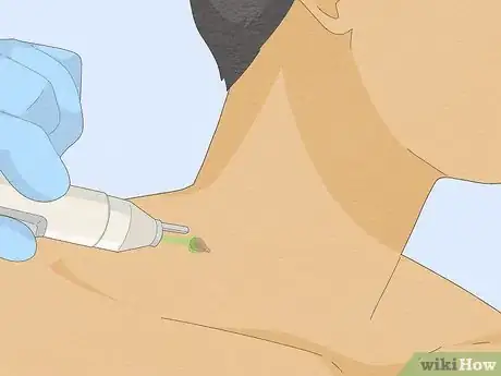 Image titled Remove a Skin Tag from Your Neck Step 6