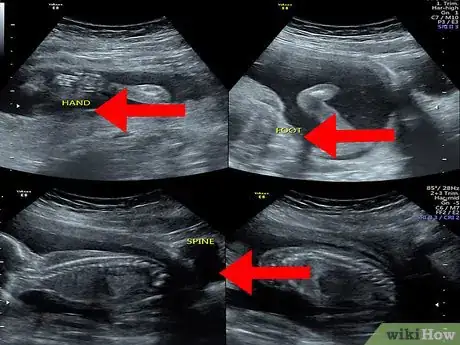 Image titled Read an Ultrasound Picture Step 6