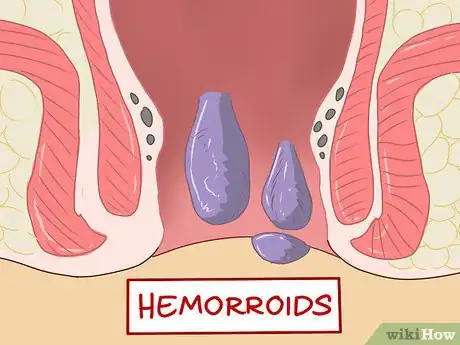 Image titled Care for Hemorrhoids Postpartum Step 1