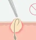 Get Rid of Ingrown Pubic Hair