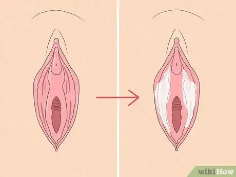 Image titled Recognize Vulva Cancer Symptoms Step 6