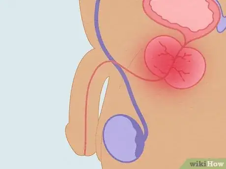 Image titled Recognize Chlamydia Symptoms (for Men) Step 7