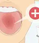 Heal a Sore Tongue