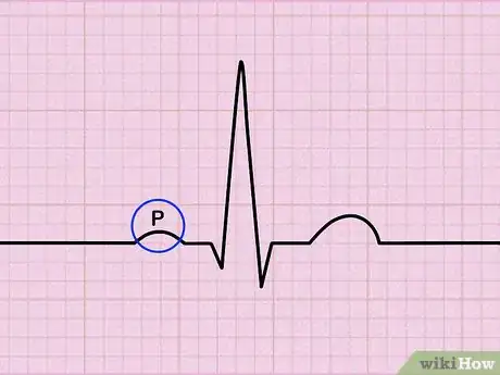 Image titled Read an EKG Step 3