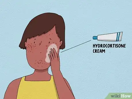 Image titled Recognize an Allergic Reaction Step 19