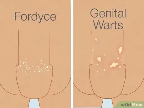 Image titled Get Rid of Fordyce Spots Step 11