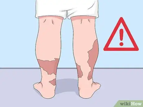 Image titled Prevent Bruising Step 12