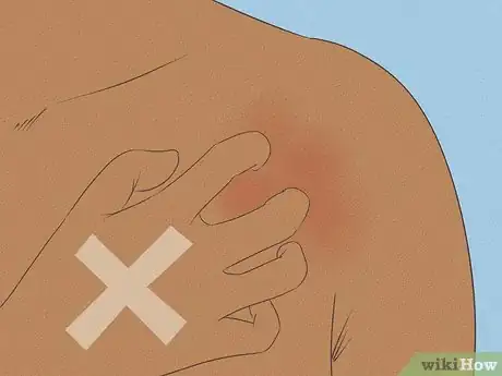 Image titled Remove Sunburn Patches (for Indian Skin Types) Step 4