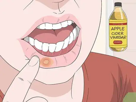 Image titled Treat Mouth Ulcers Naturally Step 5