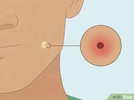 Image titled What to Do After Removing Pimple Patch Step 12