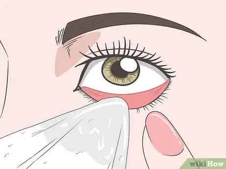 Image titled Treat Blepharitis Step 8