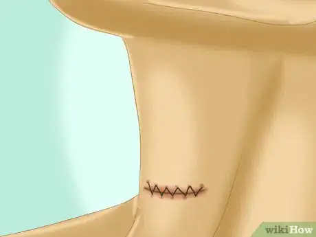 Image titled Take Care of an Incision After Thyroid Surgery Step 1