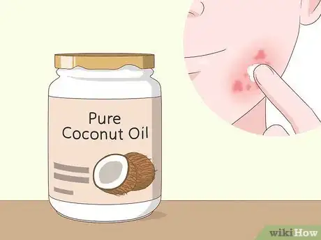 Image titled Treat a Skin Yeast Infection Naturally Step 2