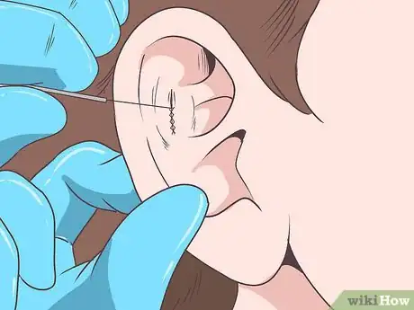 Image titled Prevent Cauliflower Ear Step 7