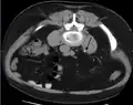 Axial CT scan of abdomen without contrast, showing a 3-mm stone (marked by an arrow) in the left proximal ureter