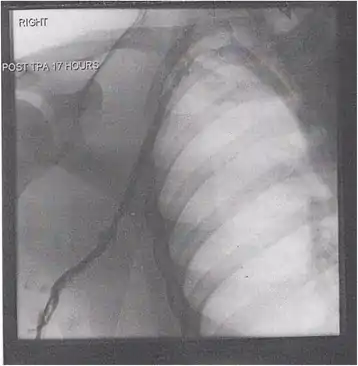 After treatment with catheter-directed thrombolysis, blood flow in the axillary and subclavian vein were significantly improved. Afterwards, a first rib resection allowed decompression. This reduces the risk of recurrent DVT and other sequelae from thoracic outlet compression.