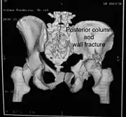 Posterior column and wall fracture as seen on 3D CT