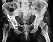 Posterior column and wall fixed using screws and plates