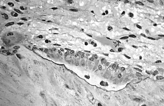 Light micrograph of decalcified  cancellous bone displaying osteoblasts actively synthesizing osteoid, containing two osteocytes.