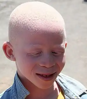 White hair caused by albinism