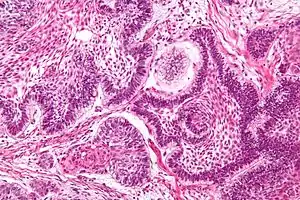 Ameloblastoma; Islands of cells with palisaded nuclei that have reverse polarization