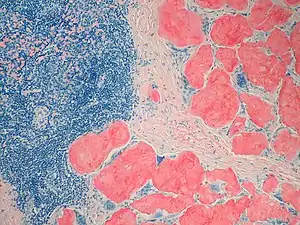 Amyloidosis, Node, Congo Red